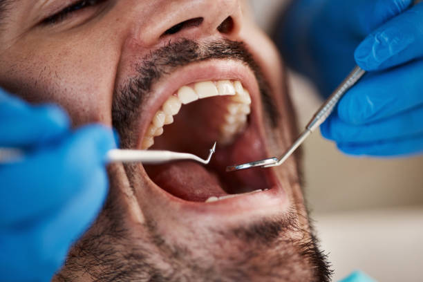Best Knocked-Out Tooth (Avulsed Tooth) Treatment in Mi Wuk Village, CA